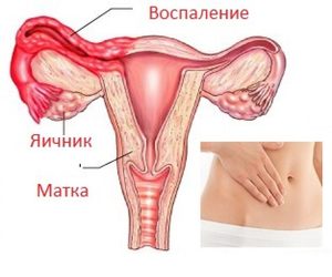 Причины воспаления придатков Как снять воспаление придатков
