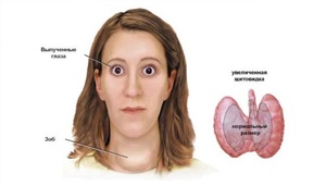 Диффузные измененеия щитовидной железы Многоузловой зоб щитовидной железы