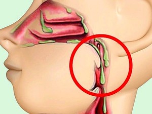 Появление слизи в горле Как удалить слизь в горле