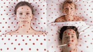 Особенности развития ветряной оспы у взрослого Признаки ветряной оспы у взрослых