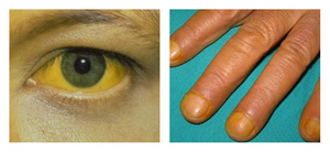 Признаки и симптомы рака поджелудочной железы Первые признаки рака поджелудочной железы