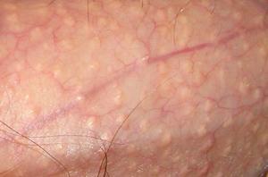 Прыщи на члене - возможные причины Появился прыщ на половом члене - проблемы с гигиеной или болезнь?