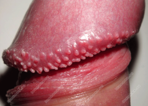 Прыщи на половом члене у мужчины Почему появляются прыщи на члене у мужчины