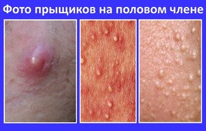 Прыщи на половом члене О чем говорят прыщи на члене и как их лечить