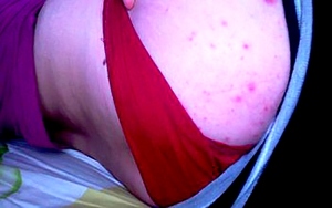 Прыщи на попе (ягодицах) - профилактика Почему могут появиться прыщи на ягодицах у мужчин и женщин