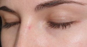 Как лечить прыщ на носу Лечение прыщей на лице