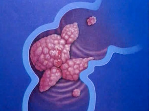 Общие симптомы проявления Лечение рака кишечника и прямой кишки
