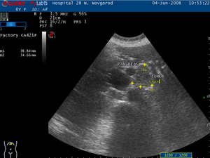 Опухоль хвоста поджелудочной железы Первые симптомы рака поджелудочной