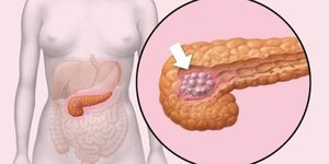Классификация стадий развития рака поджелудочной железы Признаки онкологии поджелудочной железы