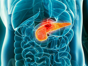 Симптомы и стадии рака головки поджелудочной железы Какие симптомы при раке поджелудочной железы