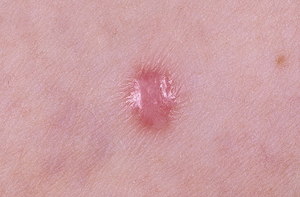 Разновидности дерматофибромы Разновидности дерматофибромы на теле