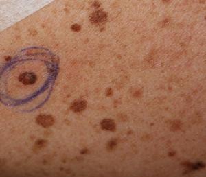 Признаки врожденных невусов Папилломатозная родинка
