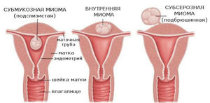 Когда удаление миомы матки необходимо Когда нужно удалять миому матки