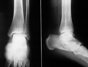 Рентген при повреждении связок голеностопа Диагностические меры при повреждении голеностопных связок