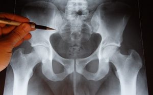 Рентген копчика Диагностика повреждений копчика