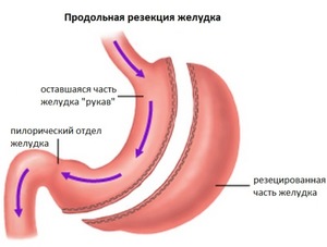 Виды резекции Диета после операции на тонком кишечнике