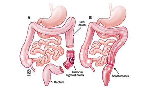 Способы операции Оперативное вмешательство