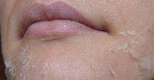 Гормональные мази от аллергии Антигистаминные кремы и негормональные мази