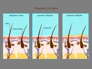 Чем лечить себорейный дерматит Питание при себорее
