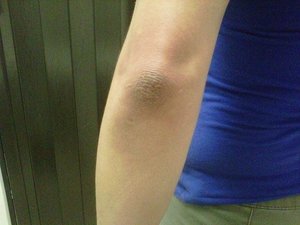 Зуд локтей Лечение зуда локтей