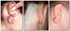 Причины воспаления лимфоузла Причины увеличения лимфоузлов