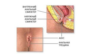 Как лечить геморрой Лечение геморроя у женщин