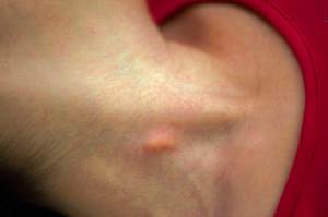 Симптомы липомотоза Как возникает липомотоз