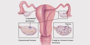 Медикаментозное лечение поликистоза яичников Поликистоз яичников лечение