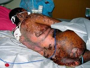 Синдром Лайелла - на фото пациент Синдром Лайелла - это один из видов острой аллергической реакции