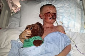 Чем опасен для детей синдром Лайелла Синдром Лайелла - заболевание смертельно опасное