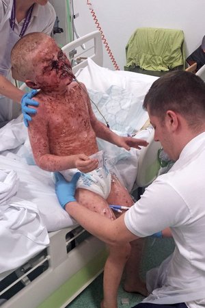 Синдром Лайелла у ребенка - диагностика Синдром Лайелла у ребенка - методы лечения