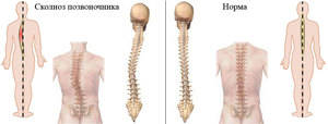 Боль при сколиозе Боль в груди при сколиозе