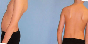 Лечение сколиоза Методика лечения сколиоза