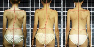 Последствия сколиоза Какие последствия несет сколиоз