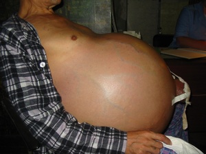 Здоровый образ жизни – это основной аспект лечения цирроза Сколько могут прожить люди с печёночной комой при циррозе печени