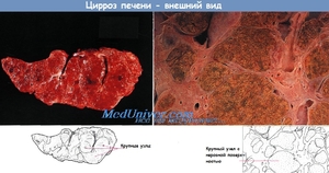 Как выглядит цирроз печени Сколько можно прожить с печёночной комой при циррозе печени