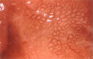 Дисплазия Состояние клеток слизистой состоит из 5 этапов