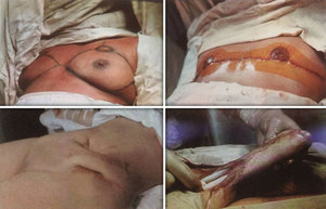 Как меняют пол с женского на мужской Как выглядят половые органы после смены пола