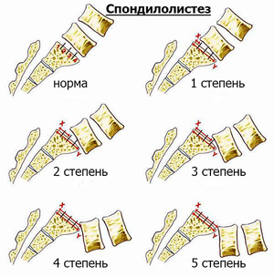 Смещение (листез) шейных позвонков бывает разной степени Смещение шейных позвонков - методы лечения