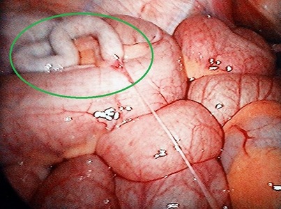 Осложнения спаечной болезни Спаечная болезнь - причины появления и лечение