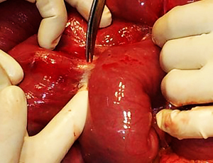 Спайки кишечника после операции: хирургическое лечение Спайки кишечника после полостной операции - как лечить