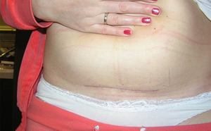 Чем опасны спайки Причины симптомы и лечение спаек