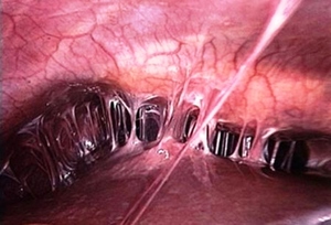 Спайки после операции фото Спайки после операции - что это такое
