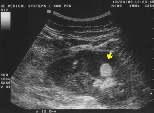 Профилактика доброкачественной опухоли Виды доброкачественных опухолей