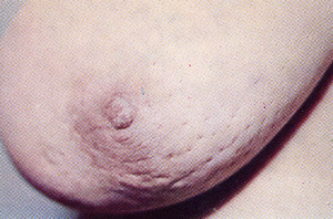 Стадии рака Стадии рака молочной железы