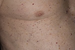Сенильные ангиомы Сенильные ангиомы у мужчиы