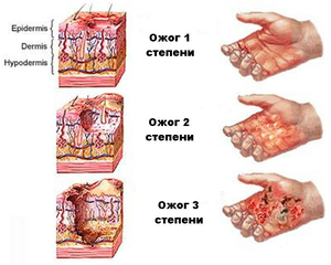 Степени химического ожога Химический ожог может быть нескольких степеней