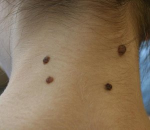 Если содрать висячую родинку Что делать, если содрал бородавку