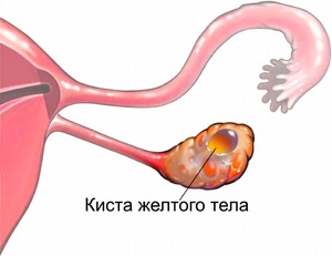 Киста желтого тела Что происходит с желтым телом в случае, если оплодотворение не произошло