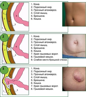 Симптомы послеоперационной грыжи Как лечить послеоперационную грыжу